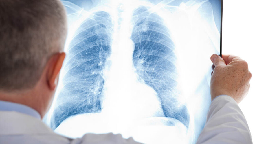 nova-tecnologia-ajuda-medicos-a-identificar-nodulos-pulmonares