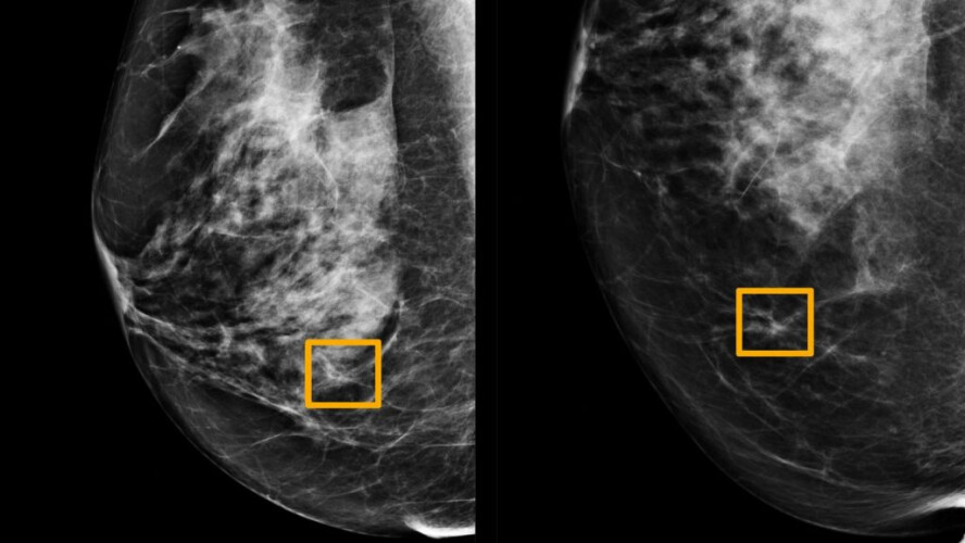 inteligencia-artificial-melhor-que-radiologistas-a-detetar-cancro