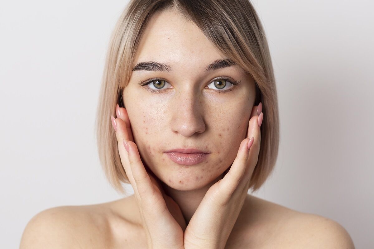 Ser&aacute; que usar base piora o acne? Temos a resposta