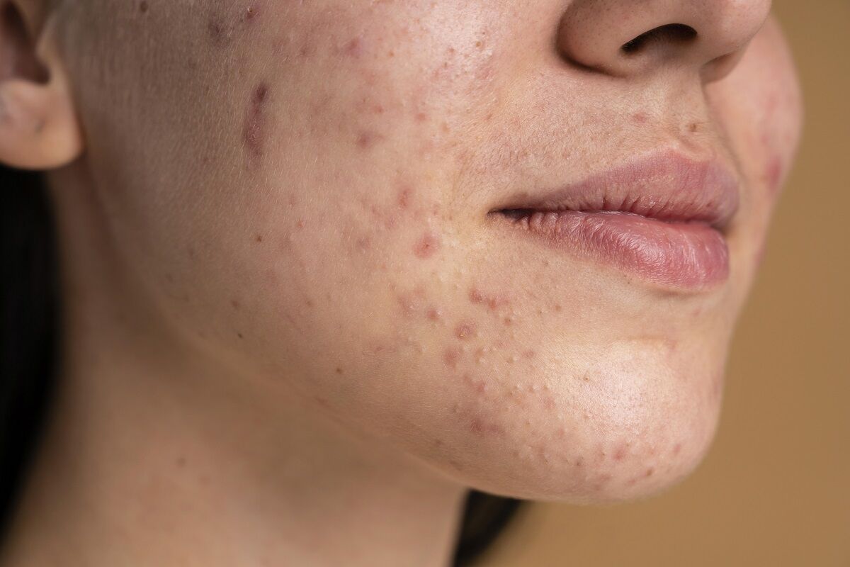 Como lidar e tratar a acne no queixo