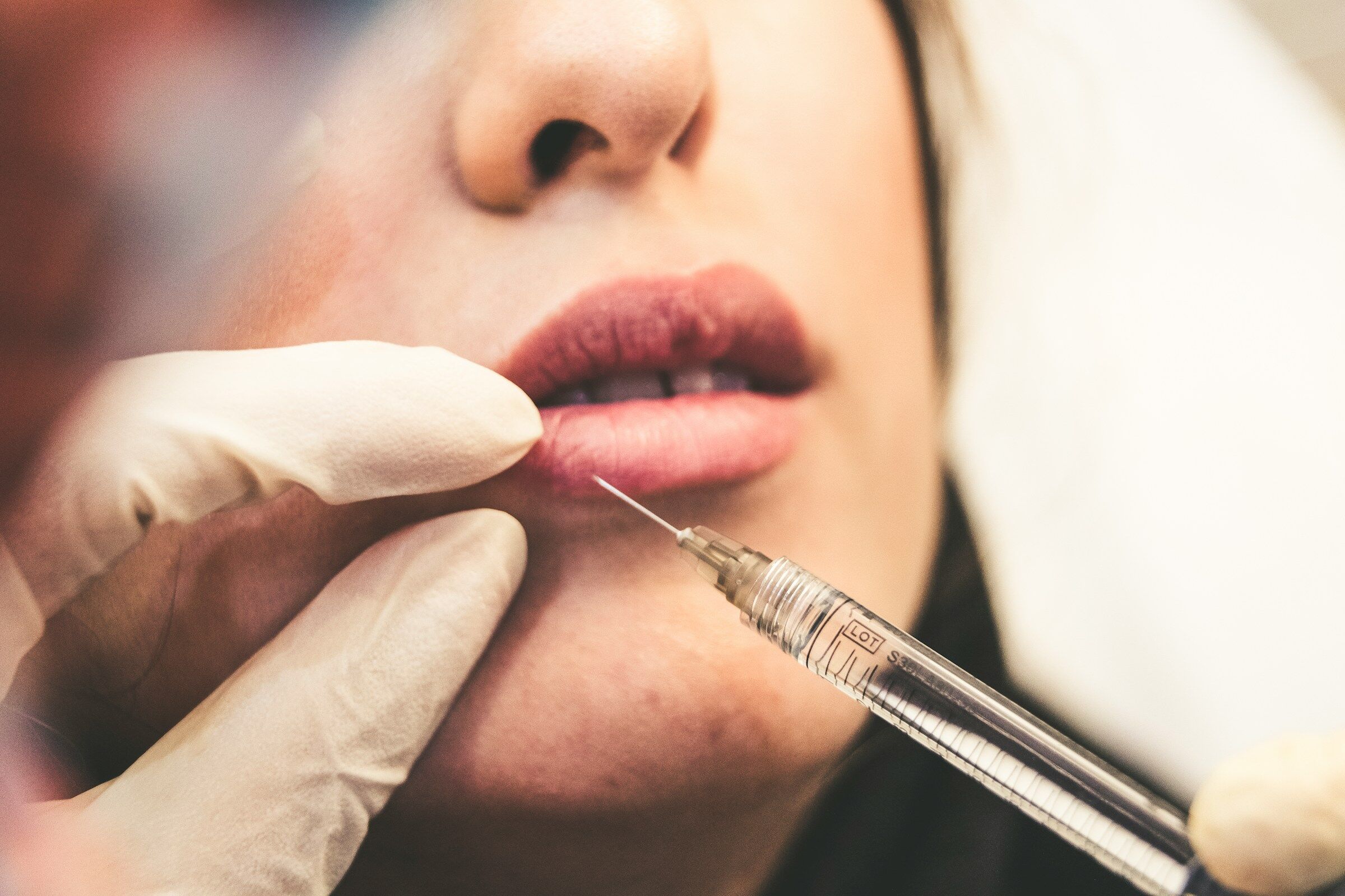 E quando o preenchimento labial corre mal, como reverter?